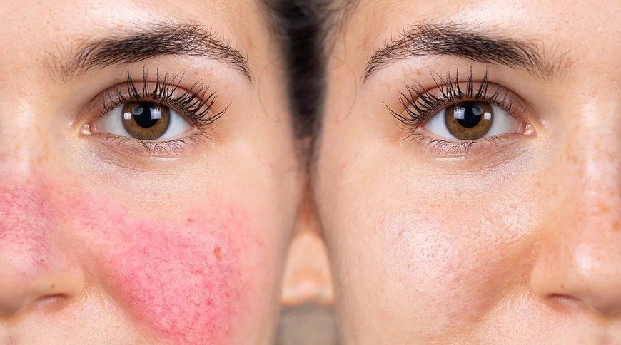 Visage > Soins rougeurs